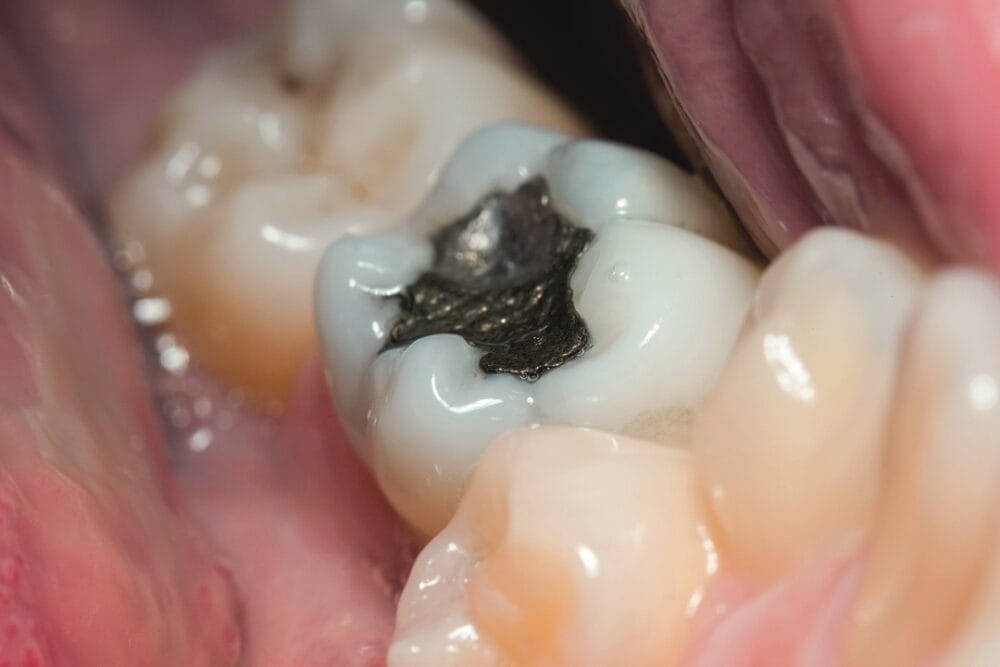 BDA: Amalgam derogation offers glimmer of hope for struggling service