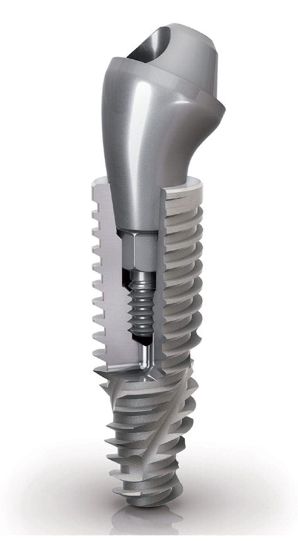 Implantology in a Single Visit