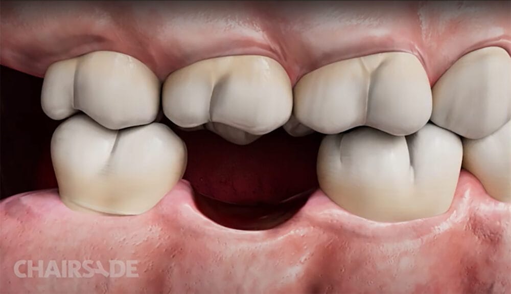 Reducing implant complications with improved patient behaviours
