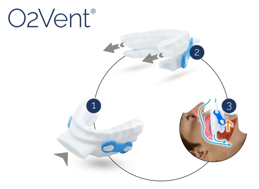 Try O2Vent®!