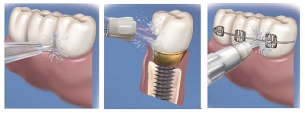 Don’t let braces get your patients down