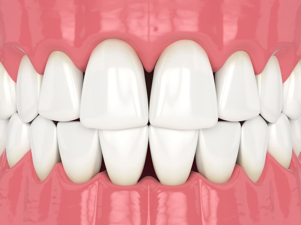 Filling the gaps in black triangle treatment