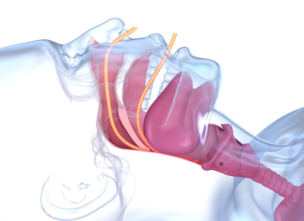 Diagnosing obstructive sleep apnoea