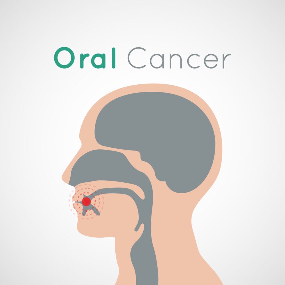 Rehabilitation after oral cancer