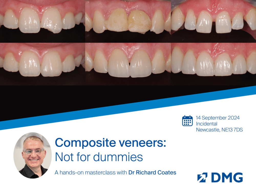 Composite veneers: Not for dummies