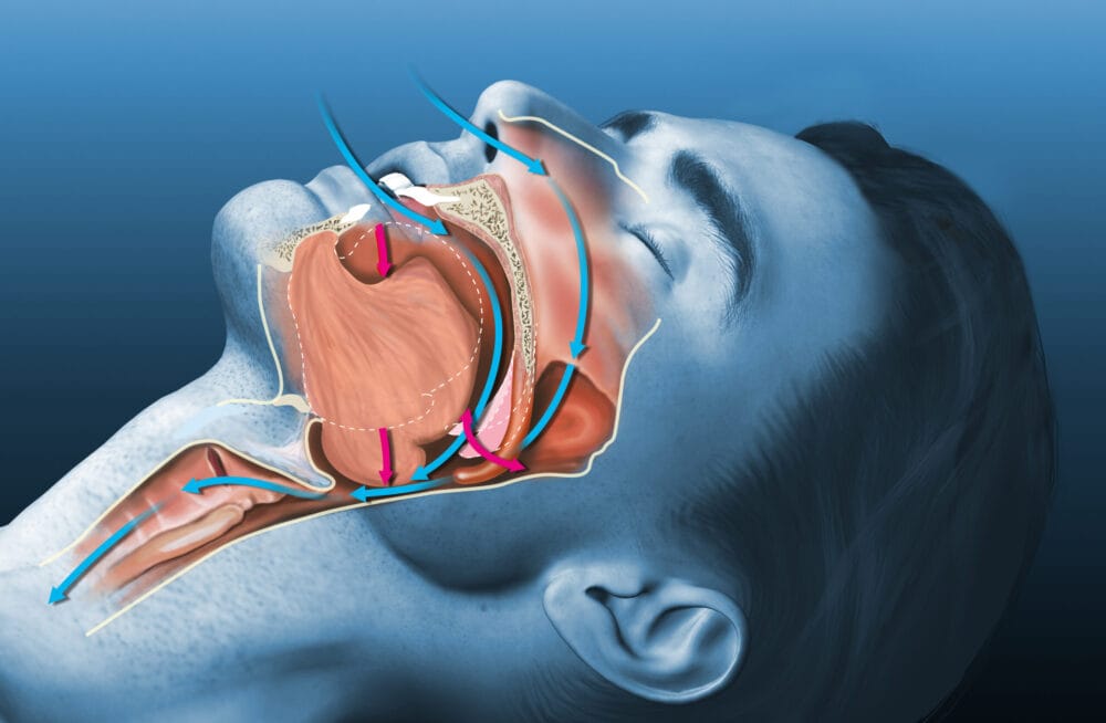 The long-term effects of sleep apnoea