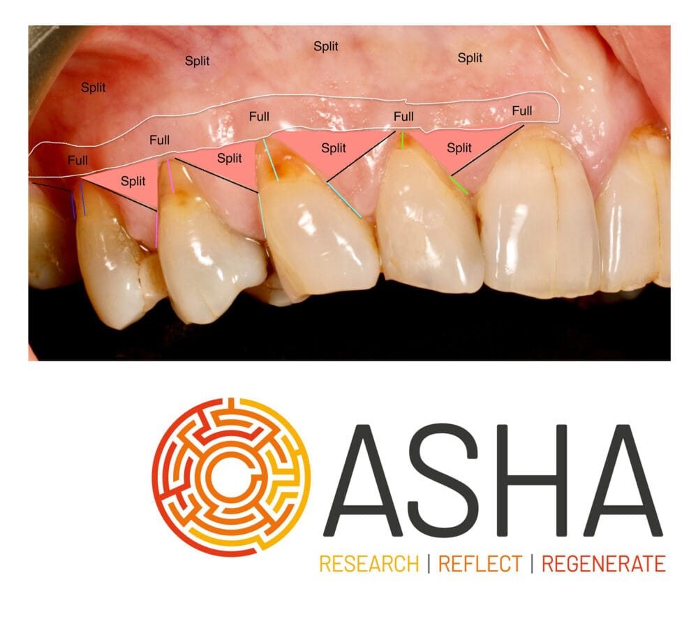 Advanced soft tissue management