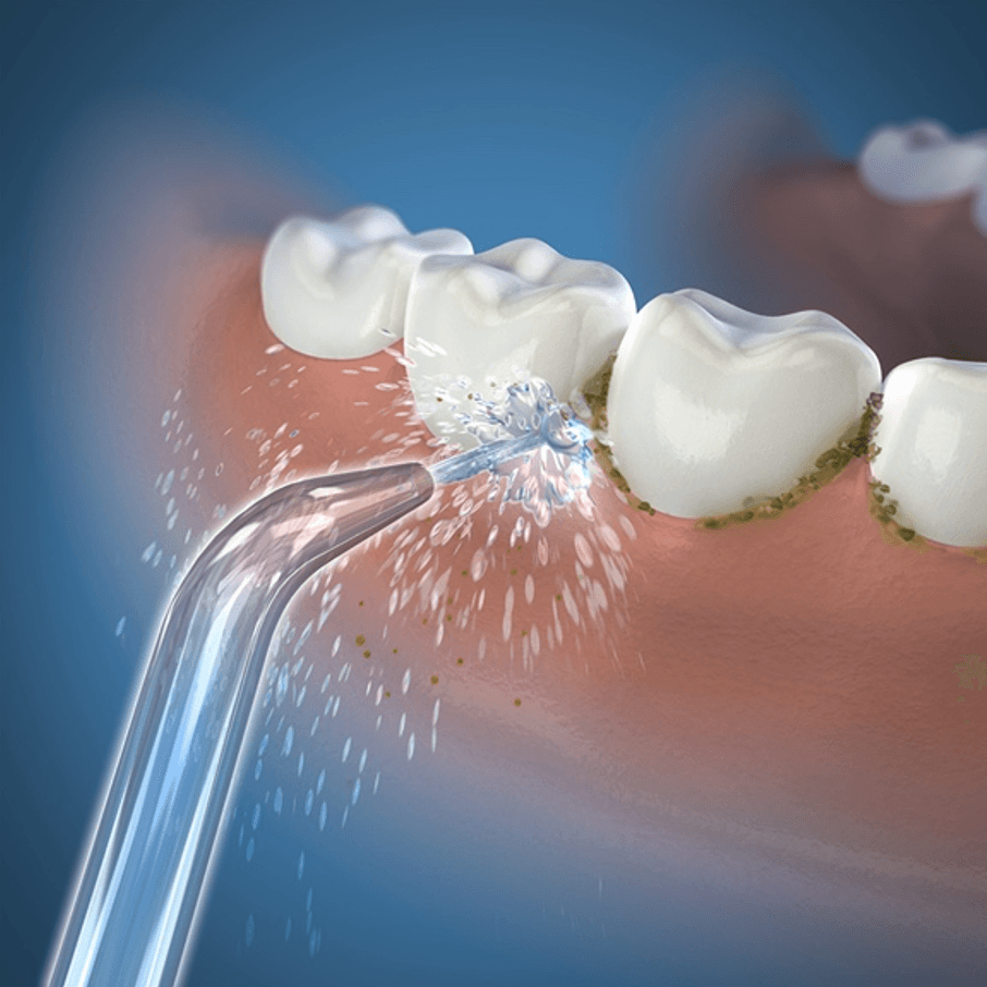 Blitzing plaque with efficiency