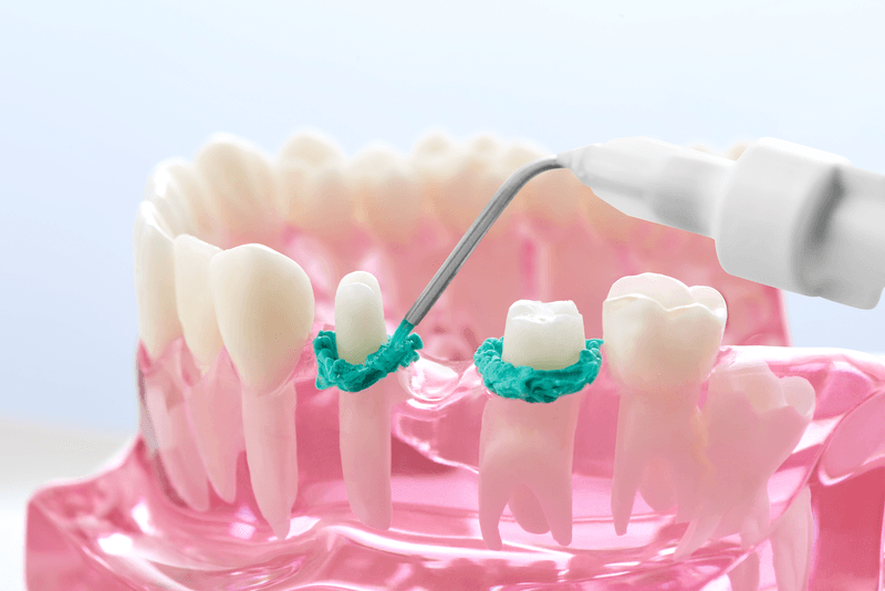Take Control of the Sulcus for Picture Perfect Digital Impressions