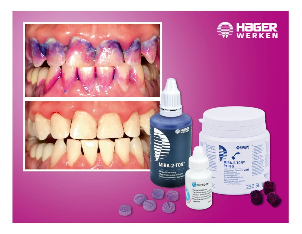Mira-2-Ton® – the products of choice when it comes to plaque detection