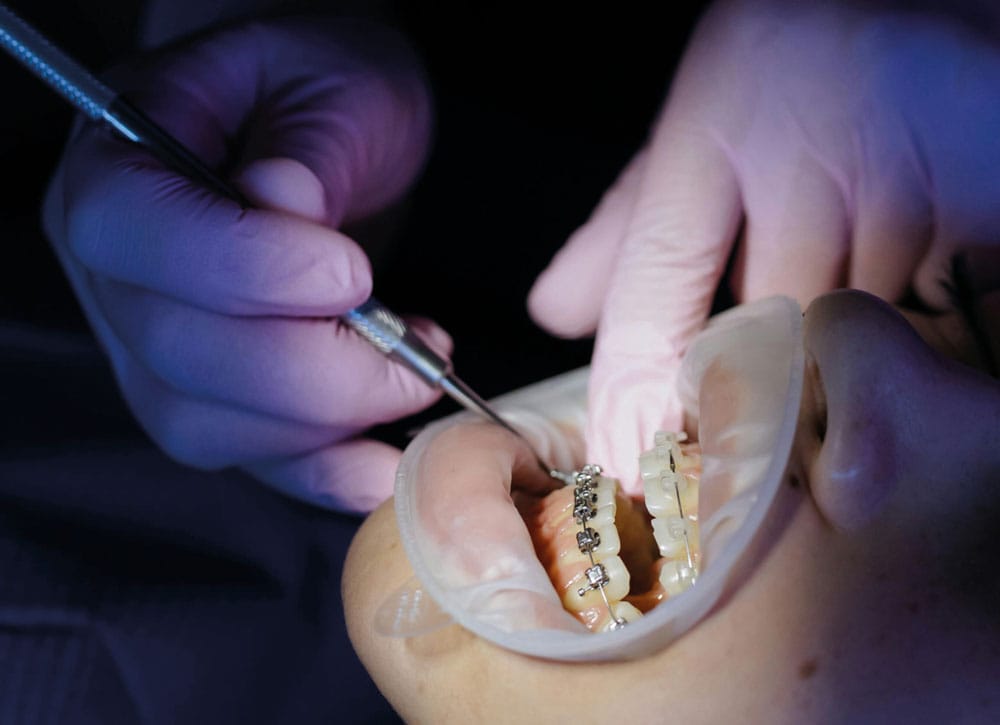 Root resorption claims: risk factors in child orthodontic patients