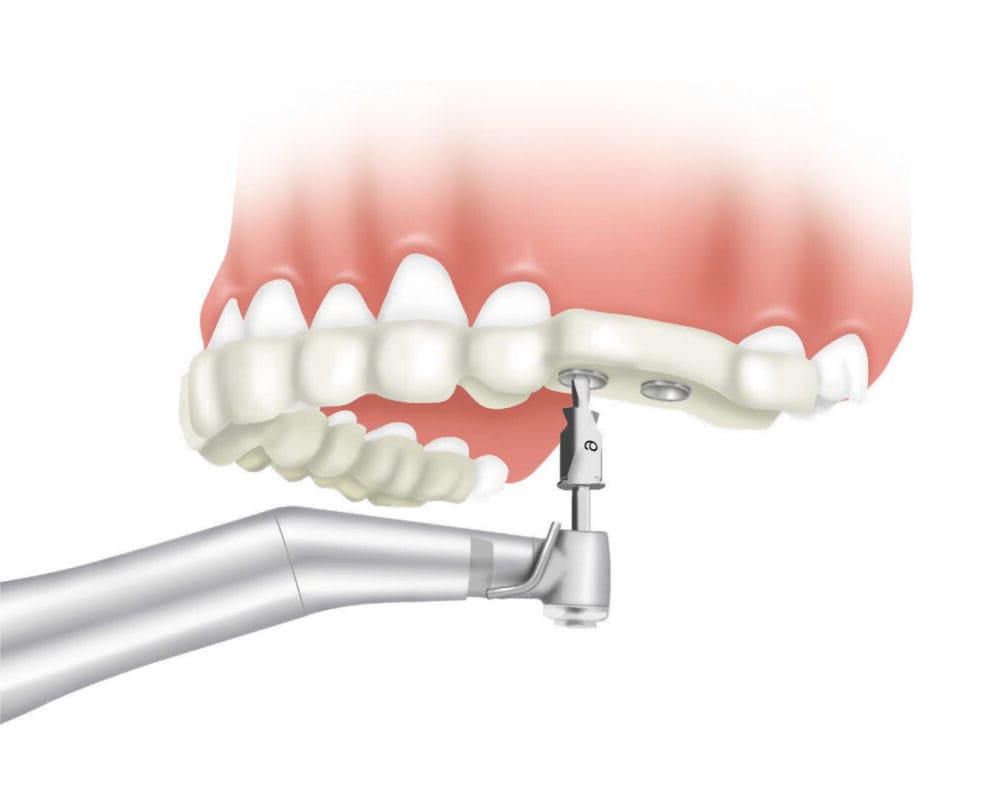 Hassle-free, predictable placement with Adin Guided Surgery!