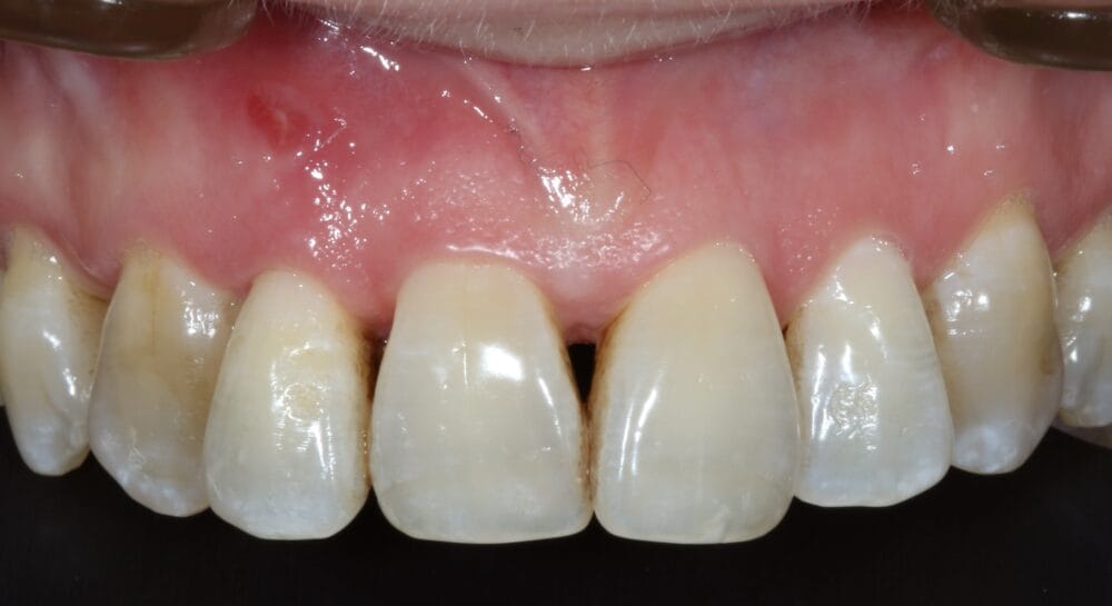 Implant replacement of the upper right lateral incisor utilising MinerOss and a connective tissue graft: a case study