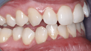Fig 3 Crowding and retroclined incisors right lateral view