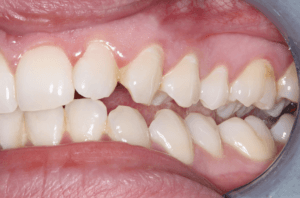 Fig 4 Class II molar realtionship between the LL% and UL5 left lateral view