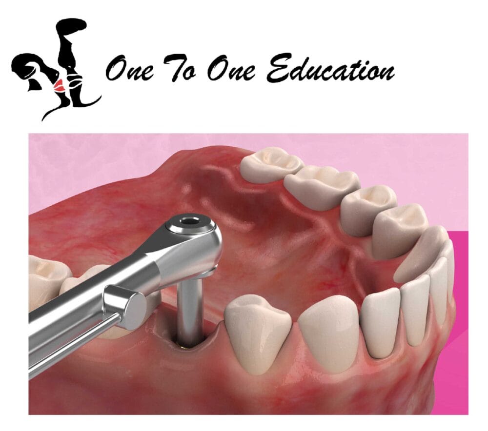 Considering dental implants? Start with confidence