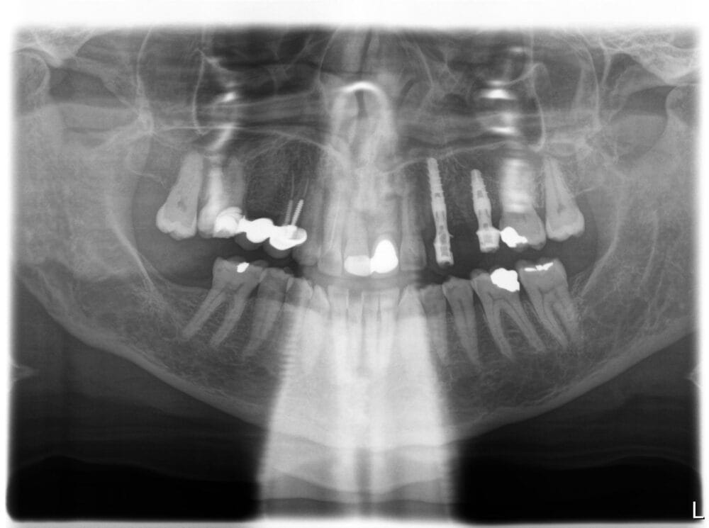 Immediate implant placement to replace a failing bridge