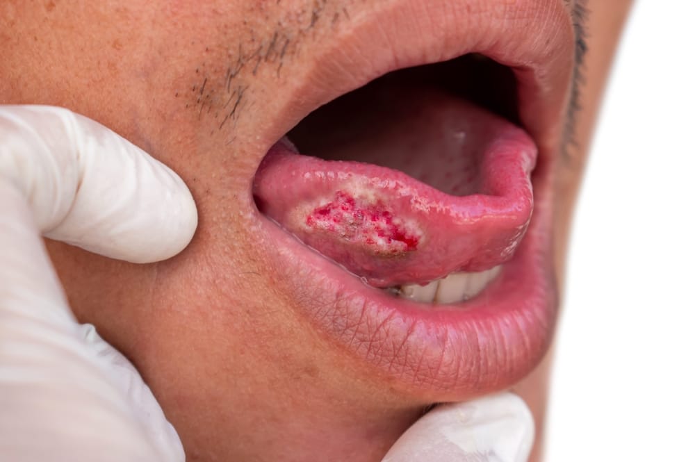Encouraging early diagnosis and supporting patients