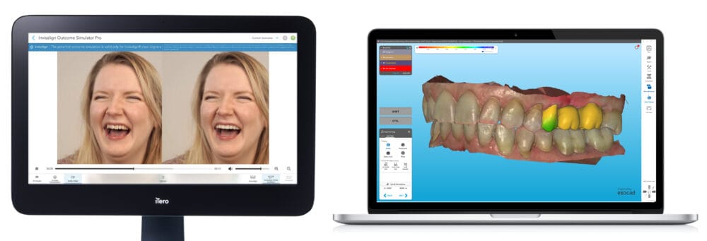 Align Technology Announces New Innovations for iTero