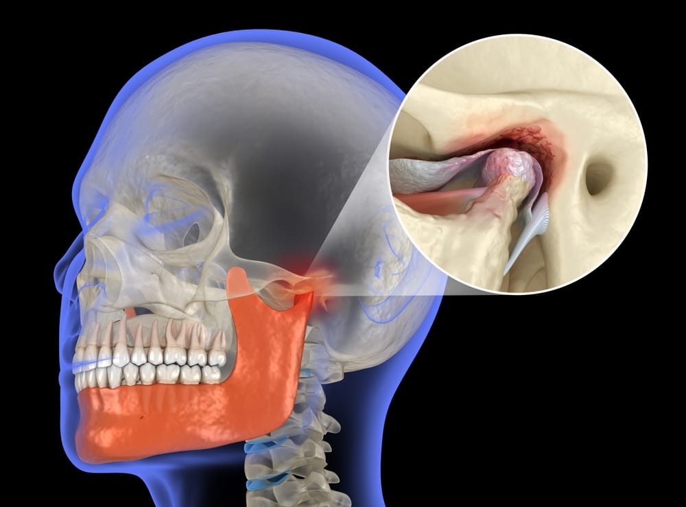Avoiding and managing temporomandibular joint disorder