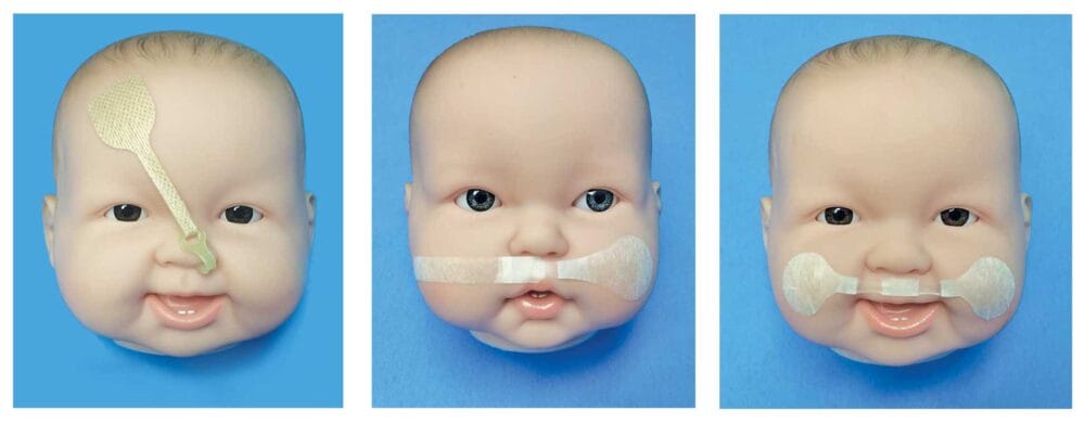 Consistency in cleft classification