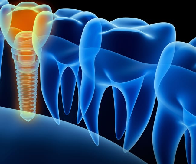 Maintaining oral care for long-term implant success