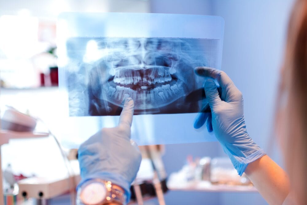 Secondary caries interpretation and adhesive choice