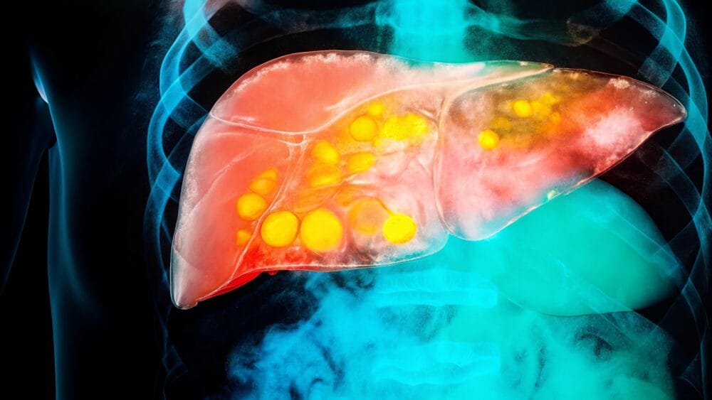 Research reveals oral health problems in patients with metabolic fatty liver disease