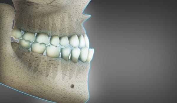 Treatment for the Class III malocclusion - The Probe
