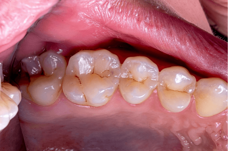 Managing staining in restorative dentistry