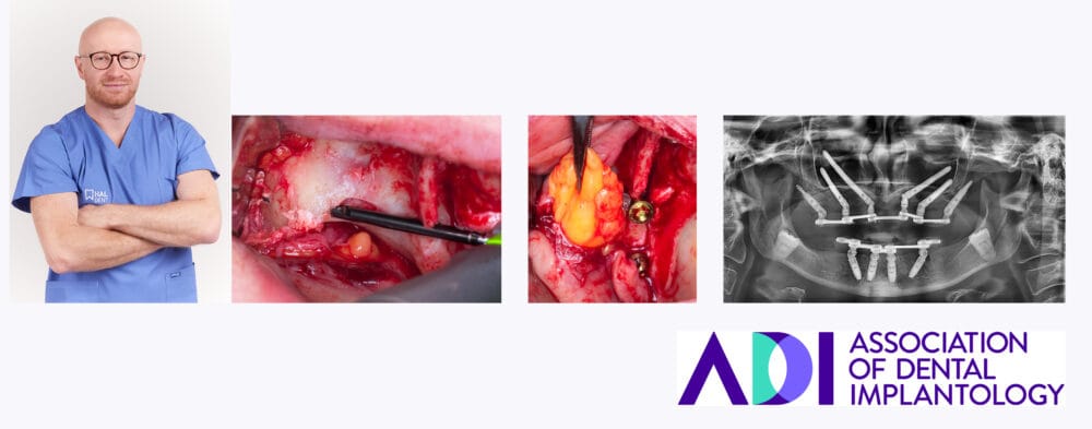 Remove the surprises from full-arch implant cases