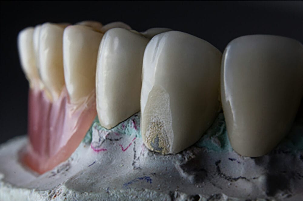 The evolution of crown materials in modern dentistry