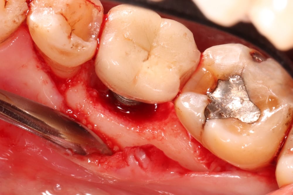 Peri-implantitis: a growing concern?