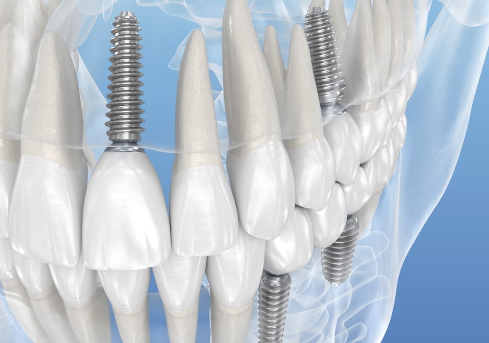 Getting implants right from the start – the importance of case selection