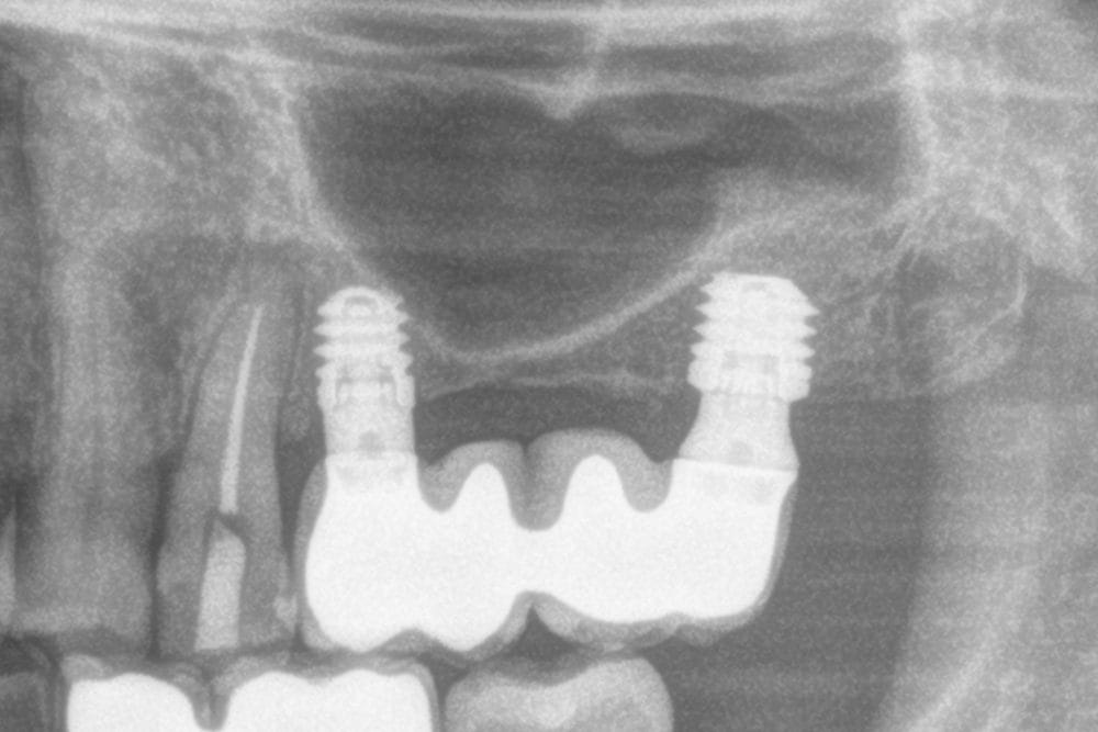 Paradigm shift in maxillary sinus elevation