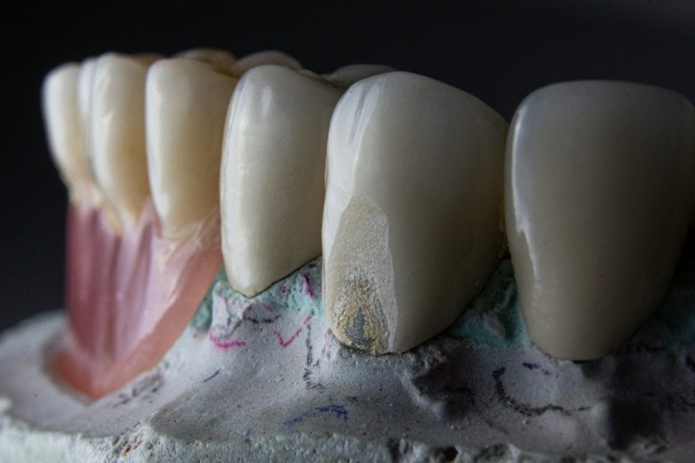 The invisible reparation of small chips in teeth