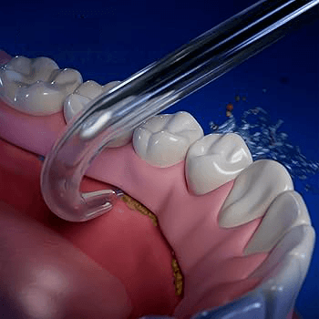 Improving implant care with Waterpik™