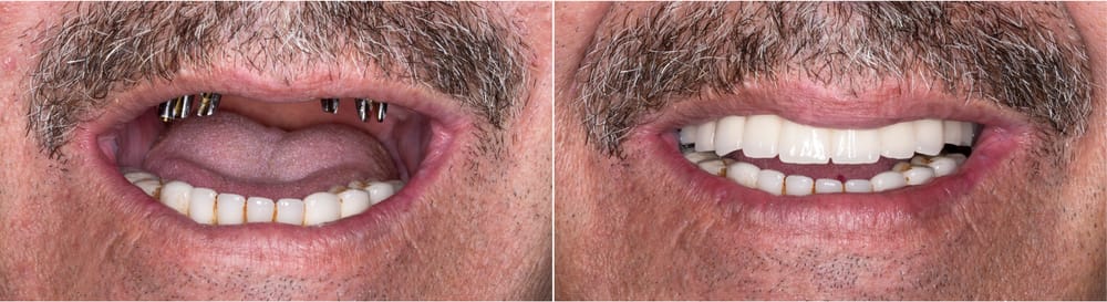 From disease to dignity: supporting patients through the full-arch reconstruction journey