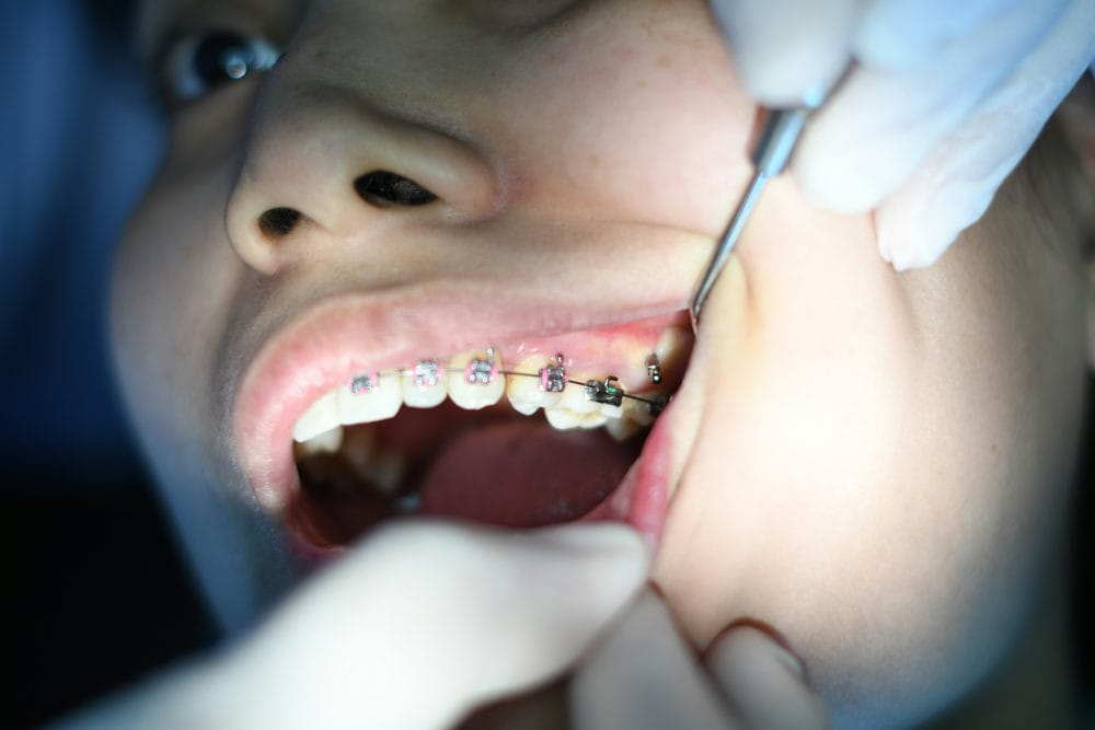 When ortho becomes an endo issue