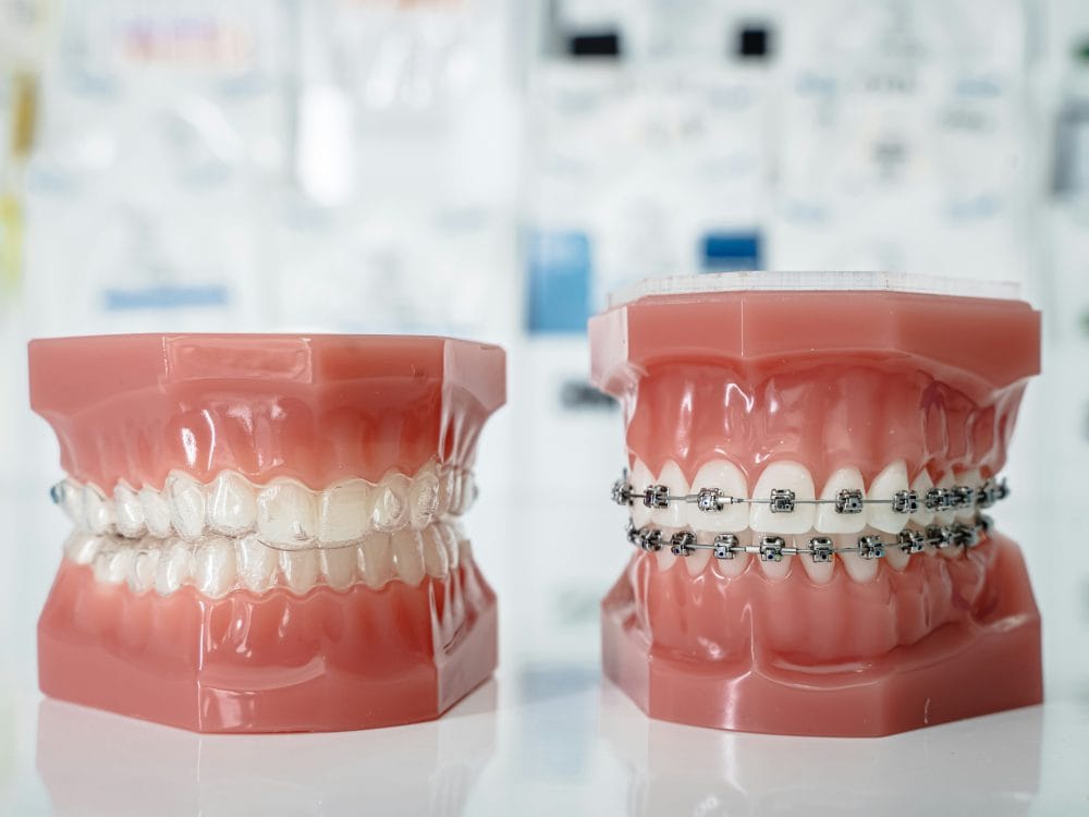 Finishing fixed brace treatment: is the last hurdle the hardest?